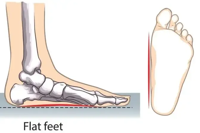 Illustration of a flat foot from the side and from below, with the arch touching the ground