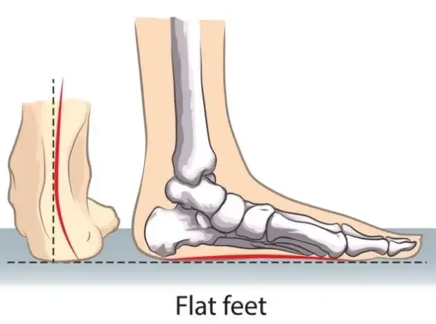 Illustration of a flat foot from behind and from the side, with the heel tilting inwards and the arch flattened