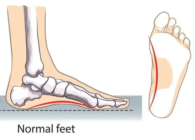 Illustration of a normal foot from the side and from below, with the arch raised off the ground